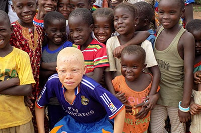 Alhassane, 12, an albino boy from Guinea, has made friends and found acceptance at a Child-Centered Space in his village.